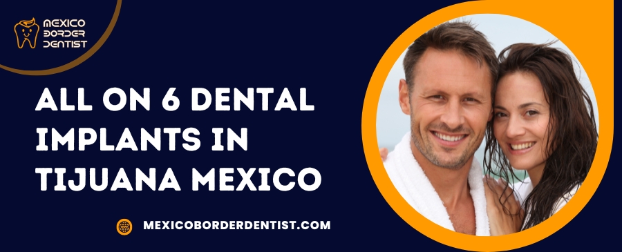 All on 6 Dental Implants in Tijuana Mexico