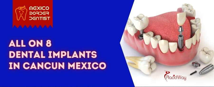 All on 8 Dental Implants in cancun Mexico