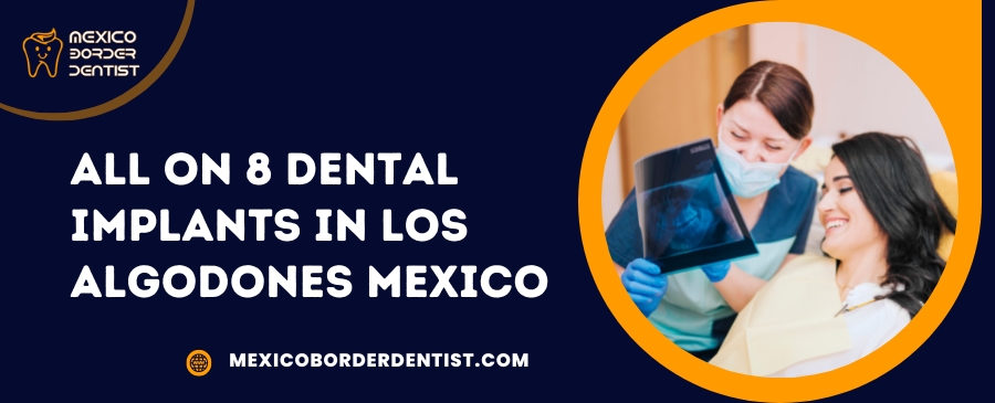 All on 8 Dental Implants in Los Algodones Mexico