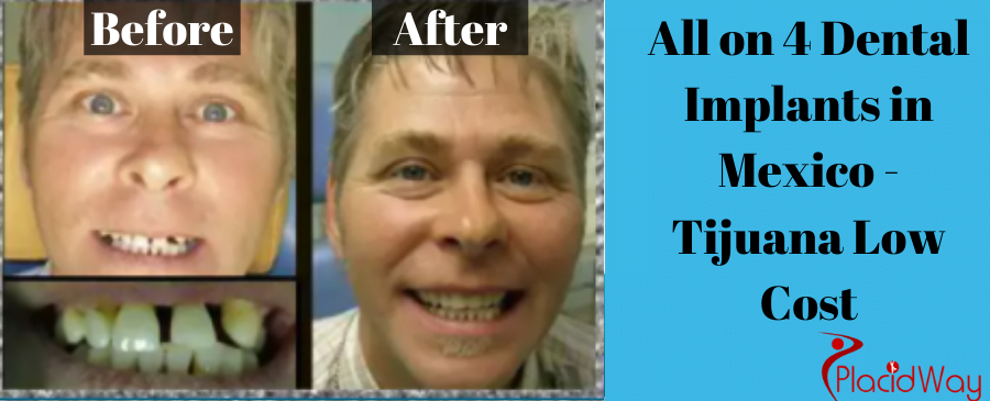 Before and After All on 4 Dental Implants in Tijuana
