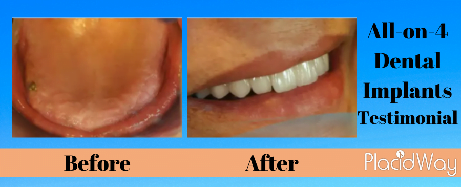 Before and After All on 4 Dental Implants in Tijuana