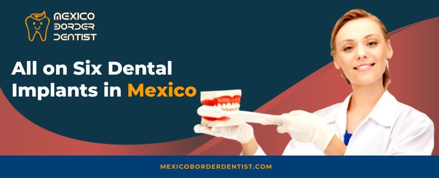 All-on-6-Dental-Implants-in-Mexico