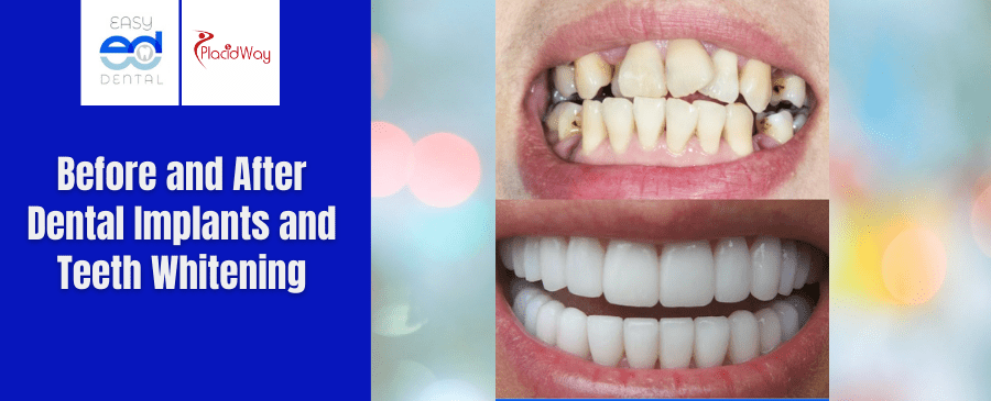 Before and After Dental Implants and Teeth Whitening in Los Algodones