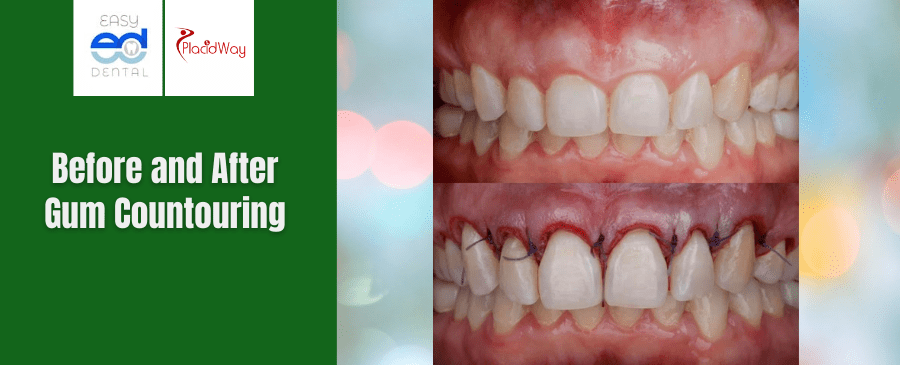 Before and After Gum Contouring in Los Algodones Mexico 