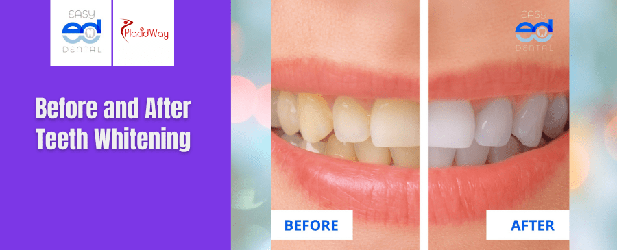 Before and After Teeth Whitening in Los Algodones Mexico 