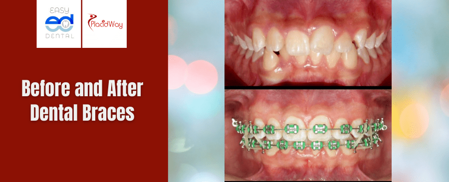 Before and After Dental Braces in Los Algodones Mexico 