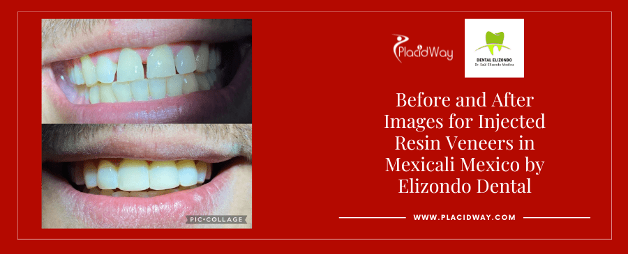 Before-and-After-Injected-Resin-Veneer-in-Mexicali-Mexico