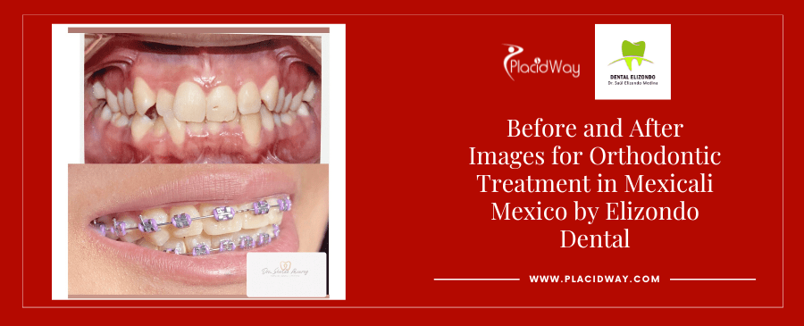 Before-and-After-Orthodontic-Treatment-in-Mexicali-Mexico