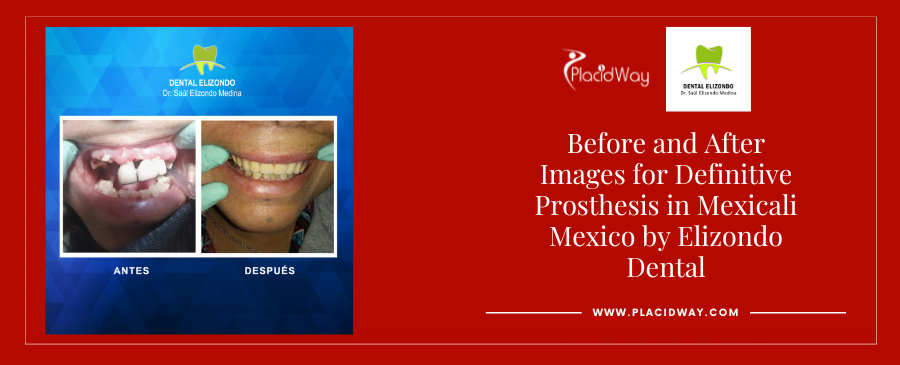 Before and After Definitive Prosthesis in Mexicali Mexico