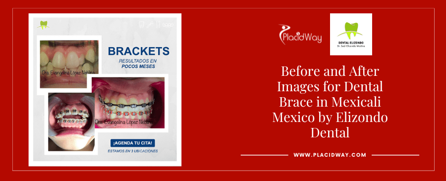 Before-and-After-Dental-Braces-in-Mexicali-Mexico