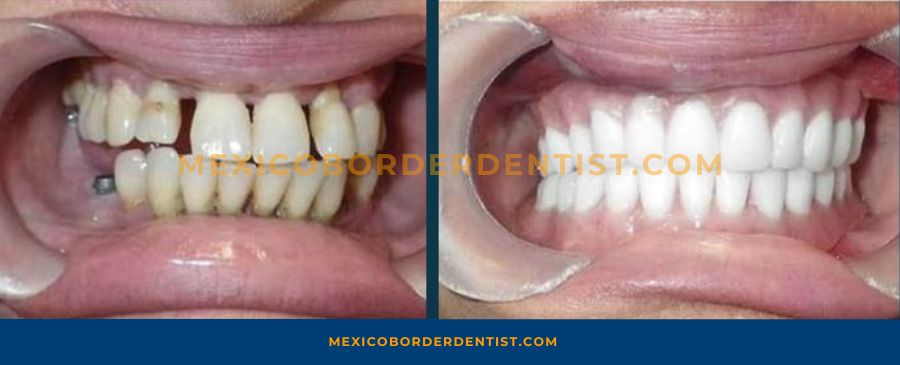 Before and After Dentures in Mexico 