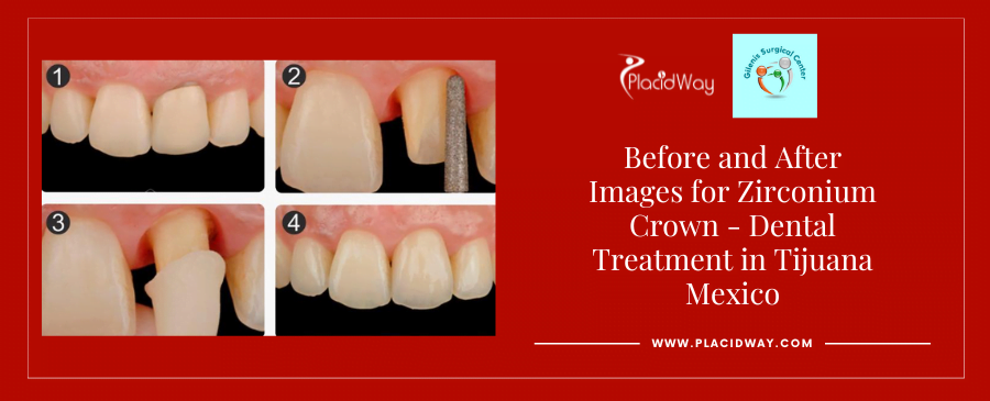 Before and After dental implant in Tijuana Mexico