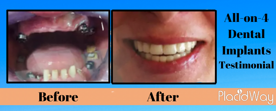 All on 4 Dental Implant testimonial in mexico