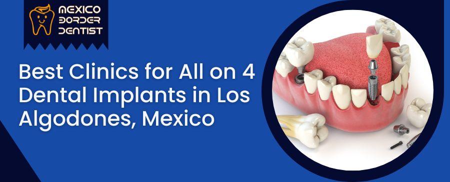 All on 4 Dental Implants in Los Algodones, Mexico