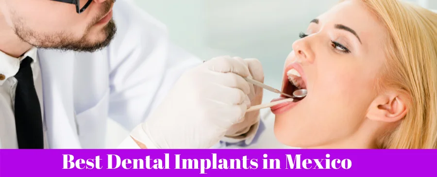 los mejores implantes dentales en mexico