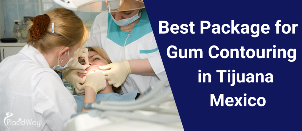 Gum Contouring in Tijuana Mexico