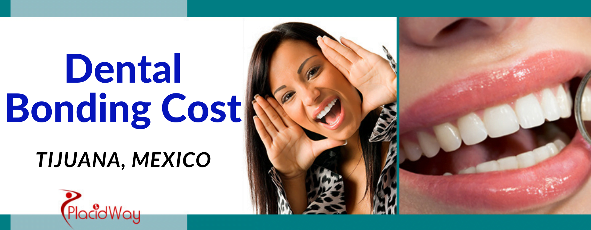 Dental Bonding Cost in Tijuana, Mexico