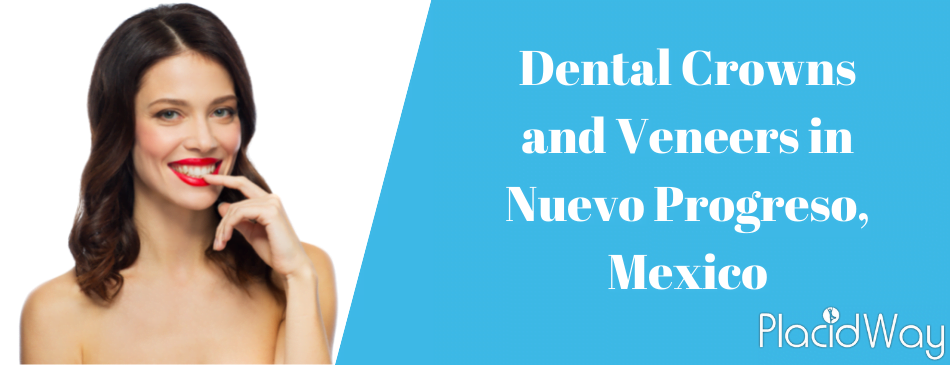 Dental Veneers and crown in Mexico