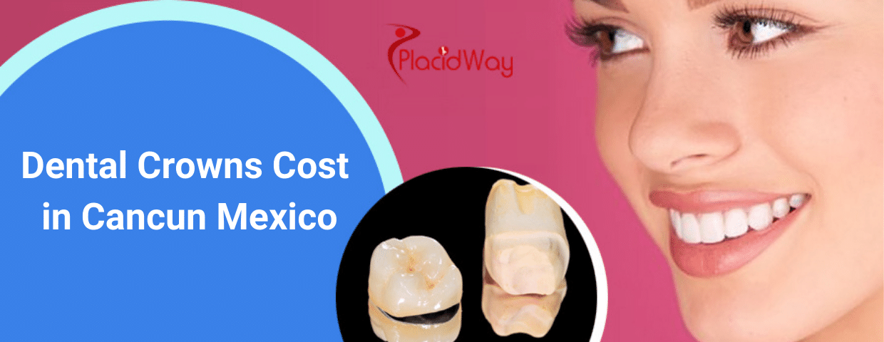 Dental Crowns Cost in Cancun Mexico