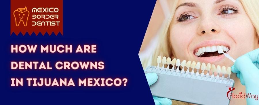 Dental Corwns in Tijuana Mexico