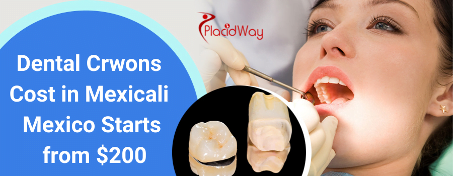 Dental Crowns Cost in Mexicali