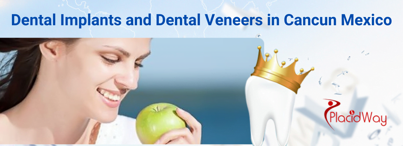 Dental Implants and Dental Veneers in Cancun Mexico