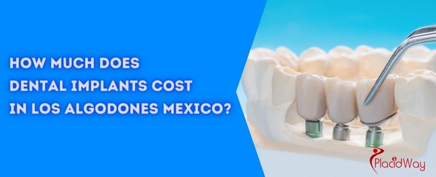 Dental-Implants-cost-in-los-algodones-mexico