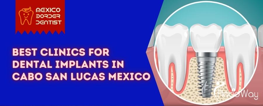 Dental Implants in Cabo San Lucas