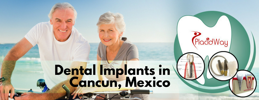 Dental Implants in Cancun