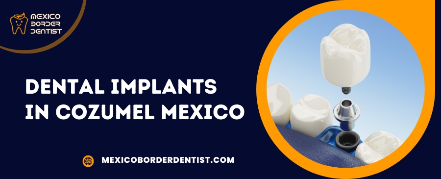 Dental Implants in Cozumel Mexico
