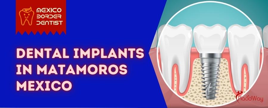 Dental-Implants-in-Matamoros-Mexico