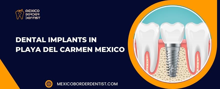 Dental Implants in Playa Del Carmen Mexico