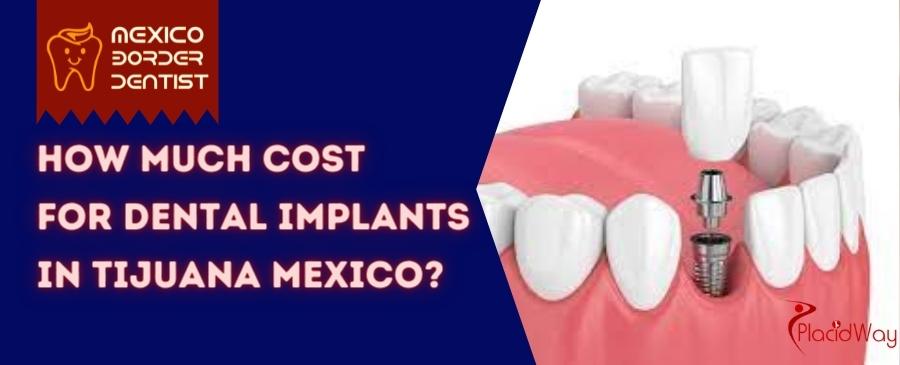 Tijuana Dental Implants Cost