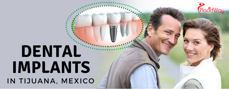 Dental Implants in Tijuana, Mexico