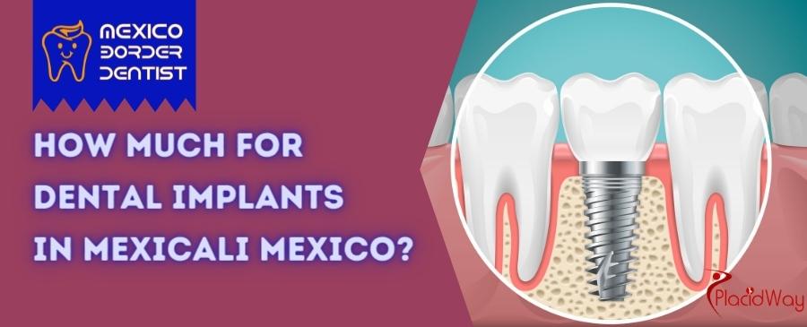 Dental Implants in Mexicali Mexico