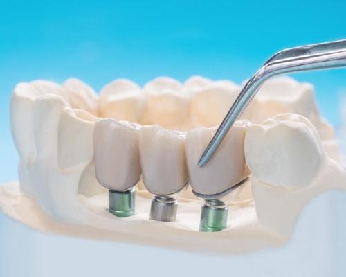 Dental implants in mexico