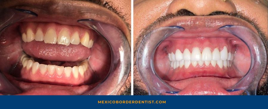 Dental Veneers Before and After in Mexico 