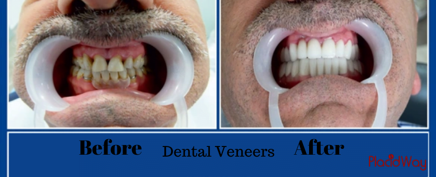 Dental Veneers Package in Mexicali Mexico