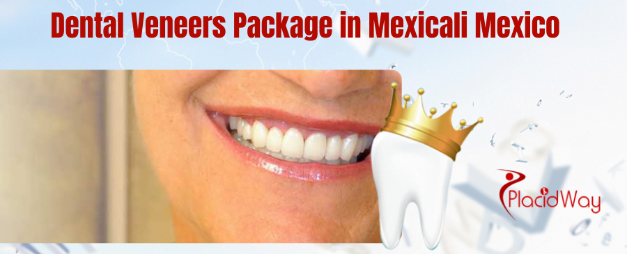 Mexicali Dental Veneers in Mexico
