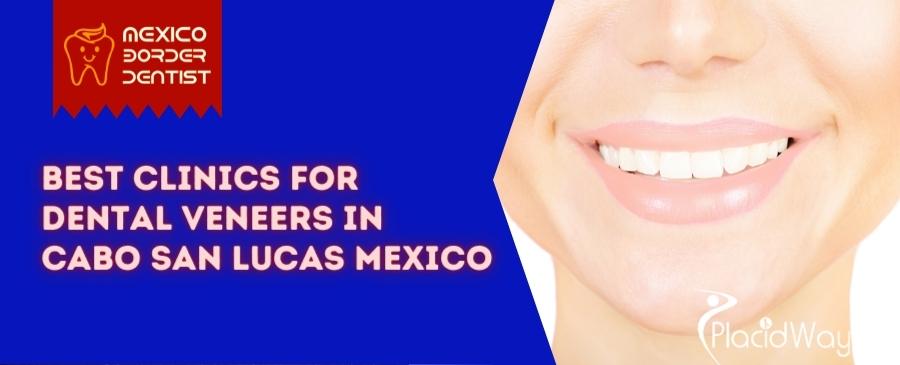 Dental Veneers in Cabo San Lucas Mexico