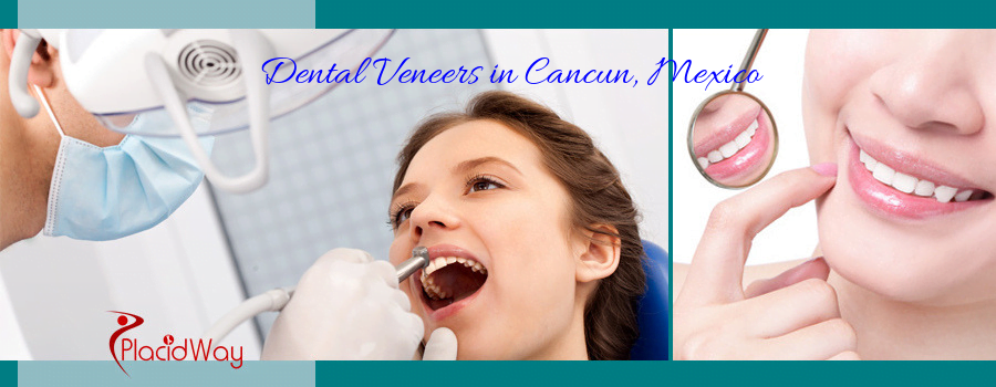 Dental Veneers in Cancun, Mexico