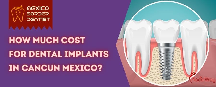 Dental-implants-cost-in-cancun-mexico
