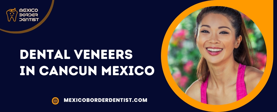 Dental veneers in Cancun Mexico