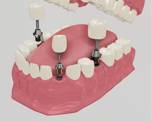 Full mouth dental implants in mexico