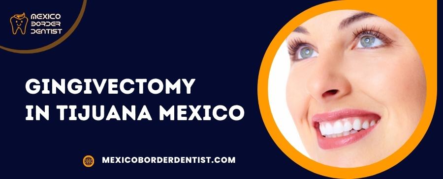 Gingivectomy in Tijuana Mexico