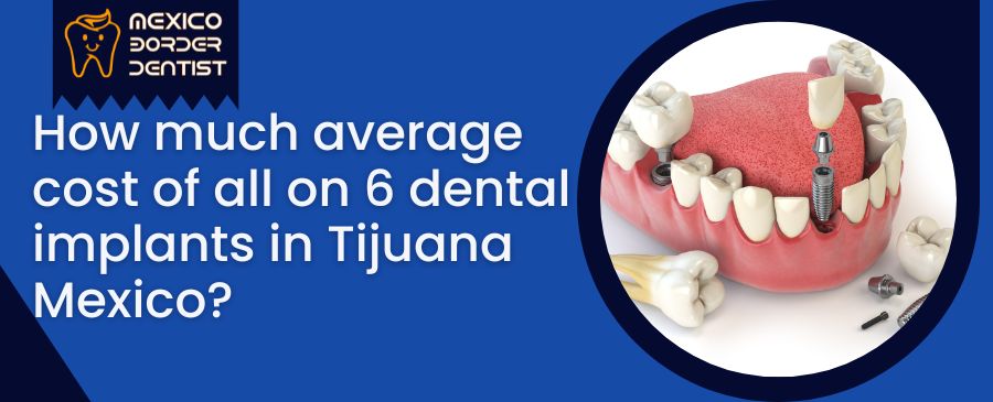 How much average cost of all on 6 dental implants in Tijuana Mexico