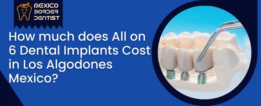 How much does All on 6 Dental Implants Cost in Los Algodones Mexico?