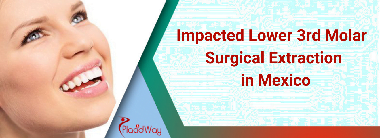 Impacted Lower 3rd Molar Surgical Extraction in Mexico