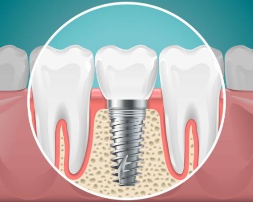 Single Dental Implants in Mexico