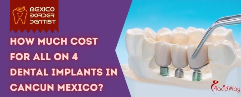 cost of dental implants in cancun mexico